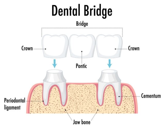 what-is-a-dental-bridge.jpg