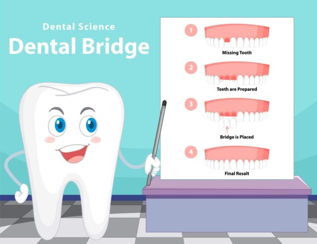 dental-bridge-procedure.jpg