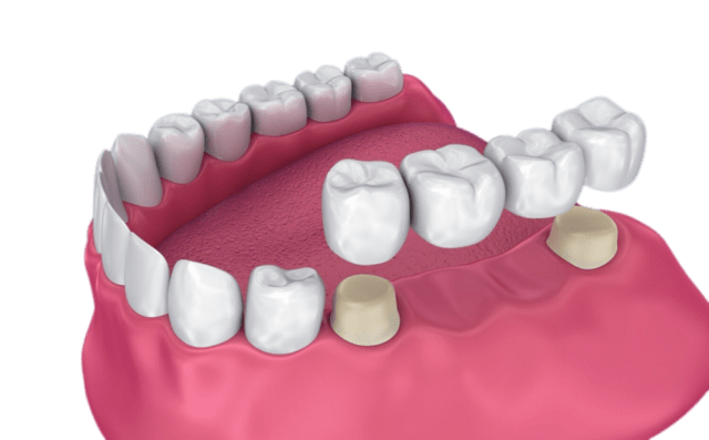 traditional-dental-bridge