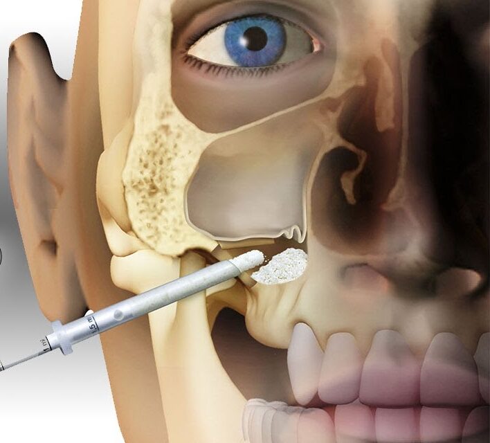 Sinus Lift Surgery: Everything you need to know