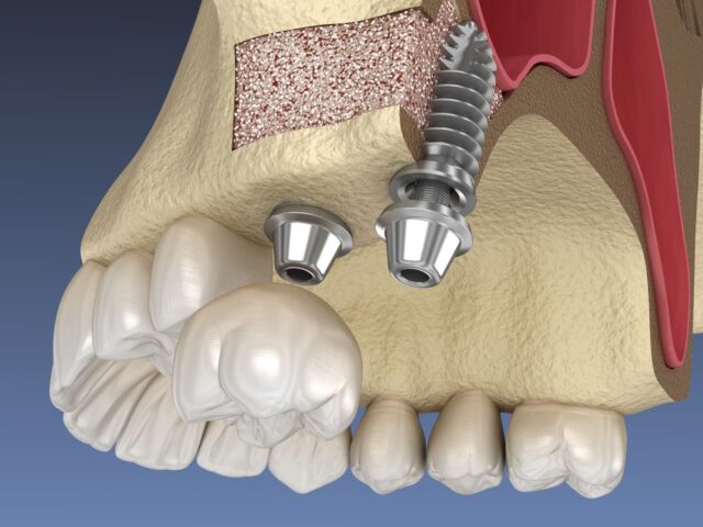 bone-graft-and-sinus-lift-surgery-with-dental-implant.jpg