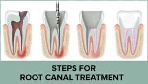 image-showing-crossection-of-teeth-for-root-canal-treatment-process