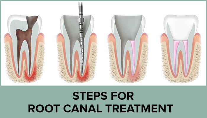 root-canal-treatment-side-effects-procedure.jpg