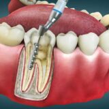 root-canal-treatment-side-effects.jpg