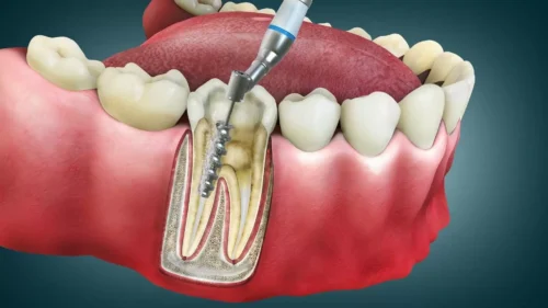 root-canal-treatment-side-effects.jpg