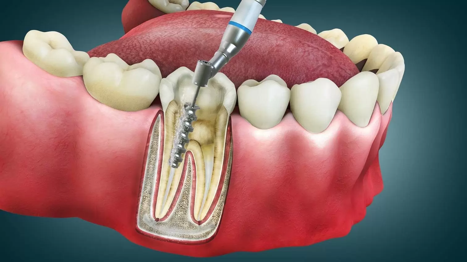 root-canal-treatment-side-effects.jpg