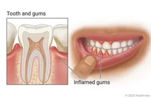 image-showing-gum-pains-and-how-it-affects-the-teeth