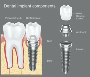image-showing-dental-implant-components