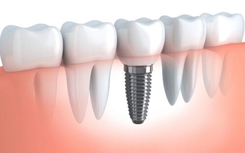 permanent-dental-implants-illustration-pic.jpg