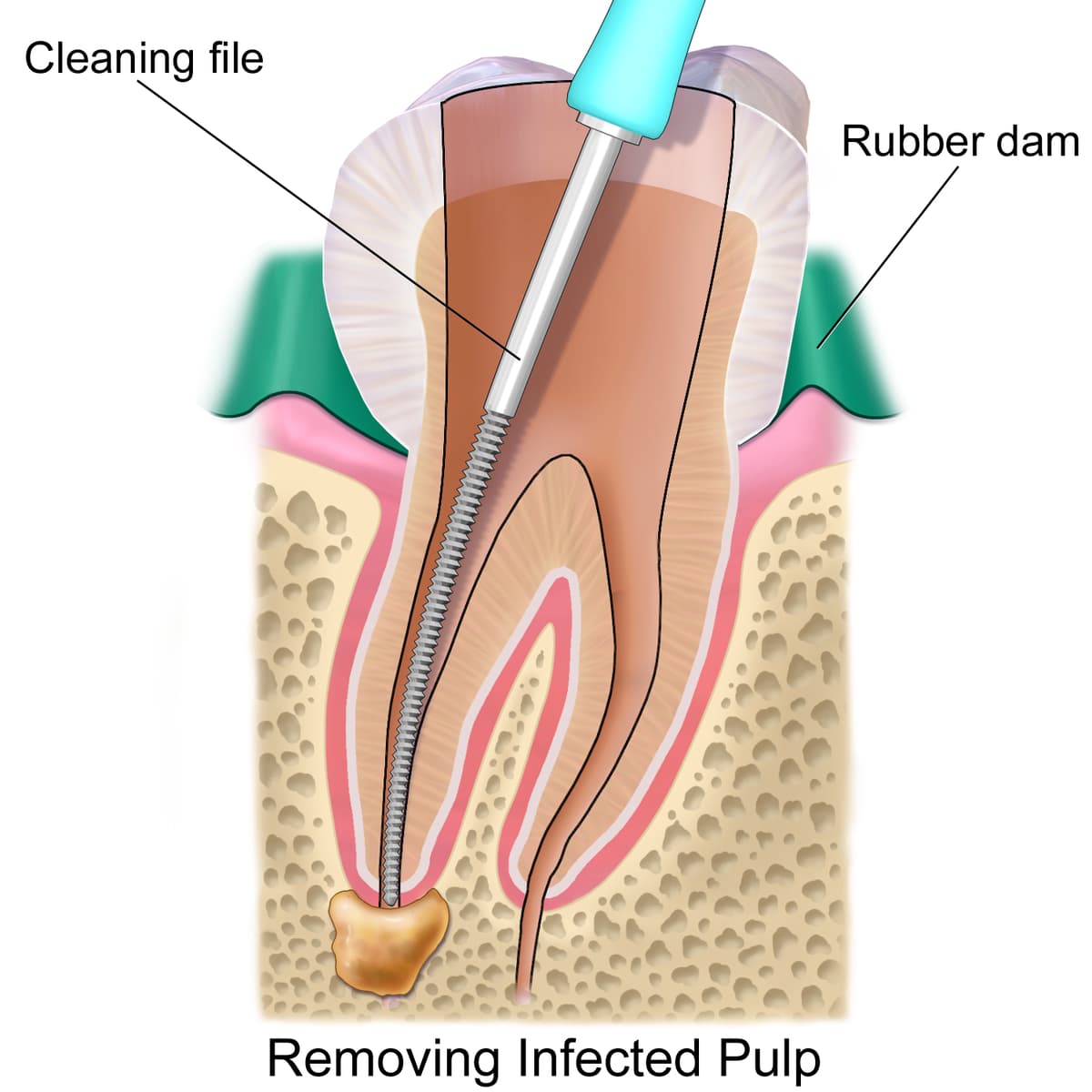 root-canal-treament-process.jpg