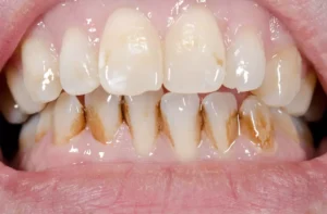 teeth-stains-example.jpg