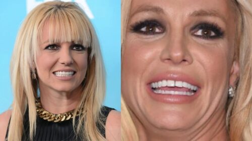 britney-spear-teeth-side-by-side-comparison