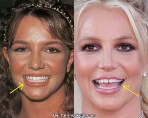 britney-spears-teeth