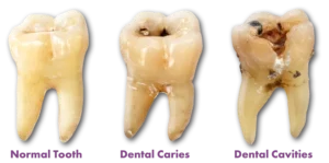 stages-of-tooth-cavity.jpg