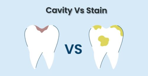 cavity-vs-stain-how-to-tell-the-difference.jpg