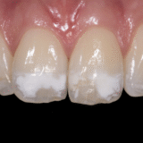 teeth-showing-white-spots-on-them