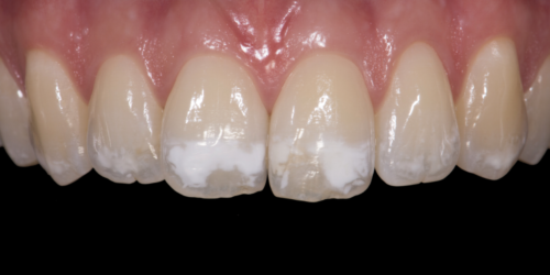teeth-showing-white-spots-on-them