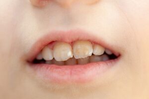 mouth-of-a-child-showing-white-spots-on-teeth