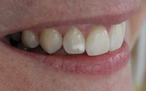 a-close-up-of-a-mouth-slightly-opened-showing-white-spots-in-teeth