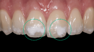 front-view-of-upper-jaw-showing-white-spots-on-teeth