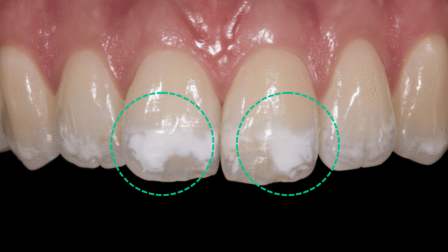 A close-up view of a person's smile, showcasing teeth with visible white spots on the enamel, illustrating the condition clearly. The foreground features the mouth, focusing on the teeth that demonstrate various sizes and shapes of the white spots. In the middle ground, soft lighting highlights the texture of the teeth, creating a realistic and clinical look. The background is a subtle, blurred dental clinic setting, with gentle tones that emphasize cleanliness and professionalism. The image should evoke a sense of curiosity and concern, inviting viewers to learn more about dental health. Shot with a macro lens to capture details, ensuring the lighting creates a balanced contrast to accentuate the white spots. Parla Clinic logo subtly placed in the corner of the image. teeth-showing-white-spots-circled-to-distinctively-show-the-spots-on-them-with-