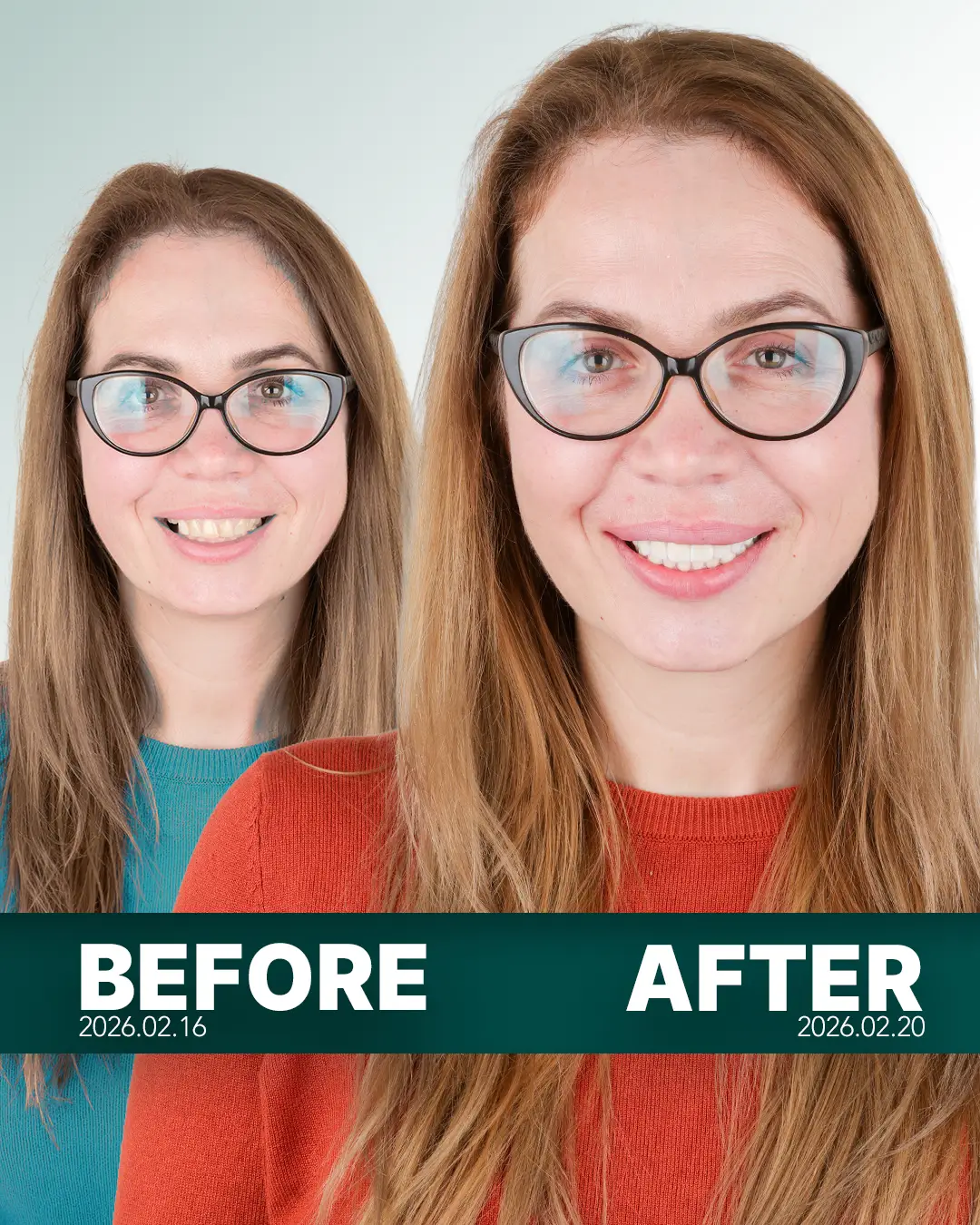 woman-smiling-showing-teeth-before-and-after-hollywood-smile-from-parla-clinic-nisantasi