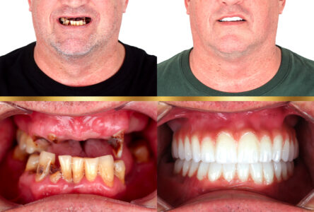 parla-clinic-patient-showing-his-teeth-before-and-after-with-his-mouth-fully-restored