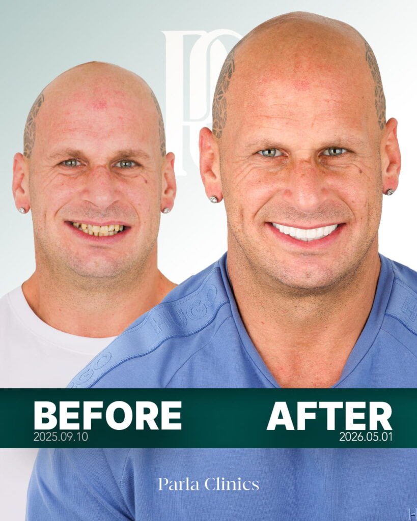 photo-of-man-showing-before-and-after-of-his-teeth-done-at-parla-clinic